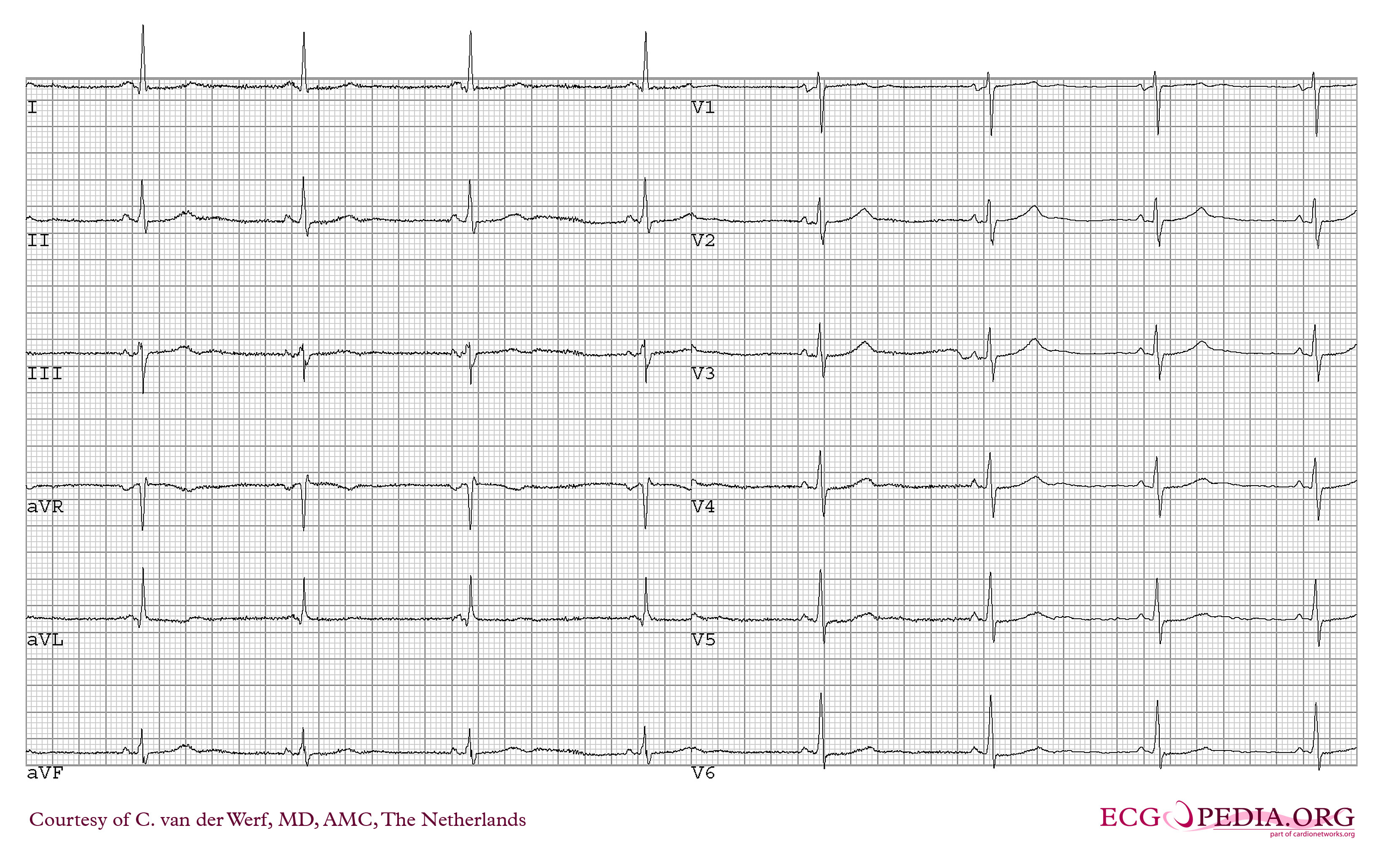 The ECG of the same patient with CPVT during exercise. Asterisks mark polymorphic ventricular beats.