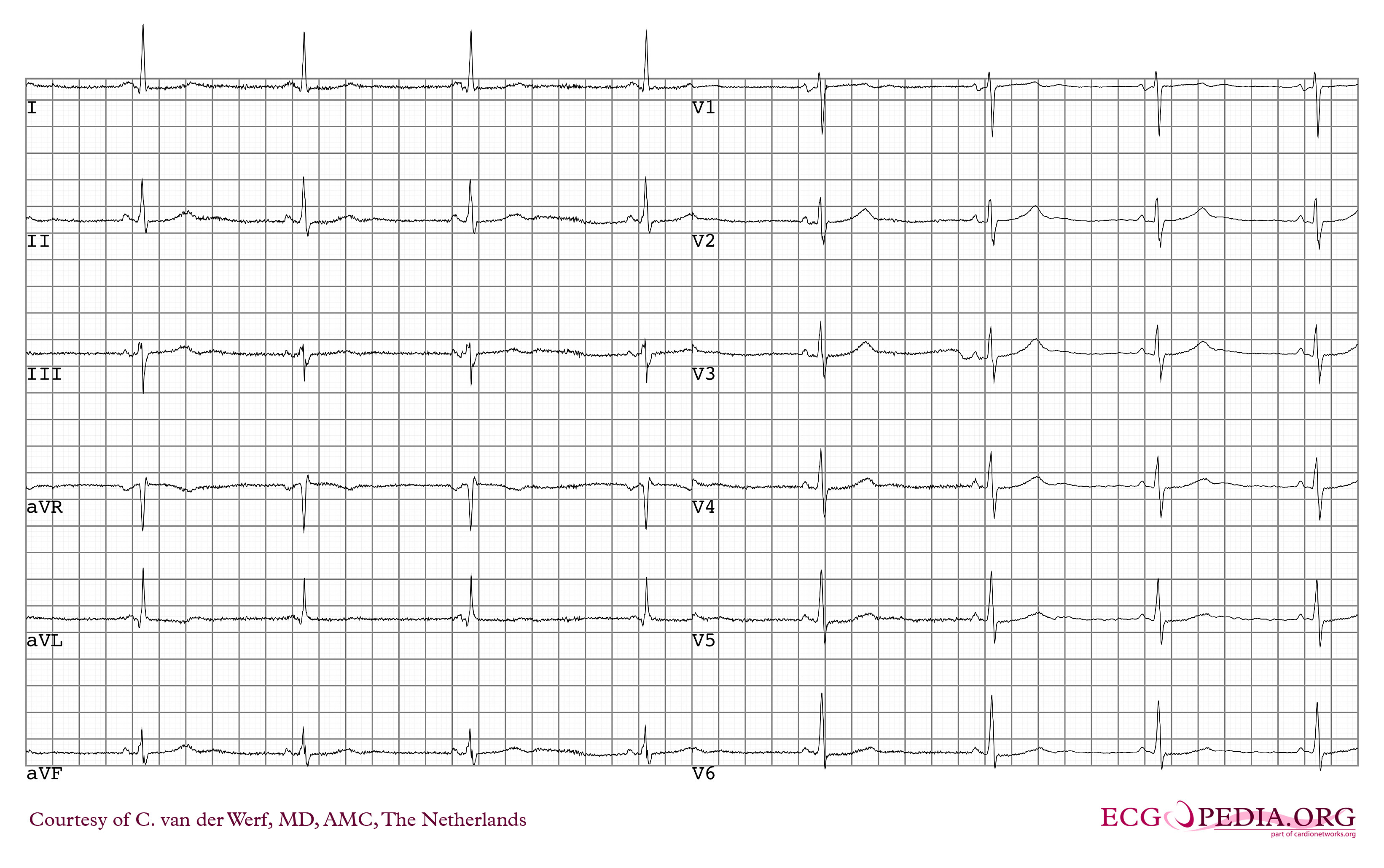 The ECG of a patient with CPVT in rest is normal