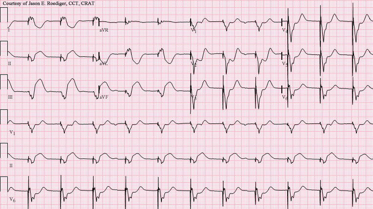 File:V-paced with acute IWMI.png