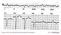 Intraventricular conduction,LBBB