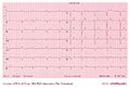 Cases,Hyperkalemia and Digoxin,AF