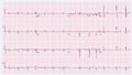 atrial fibrillation with marked organization in V1 (which is close to the right atrial appendage), this is not atrial flutter.