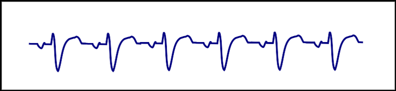 File:Atrial tachy with LBBB leadII.svg