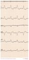 Devices,PM,Biventriculair,LBBB