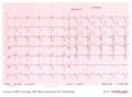 Devices,PM,Atrial standstill