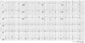 A 12 lead ECG of a patient with genetically proven LQTS3