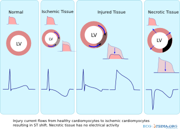 St Morphology Ecgpedia