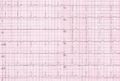 Another example of normal sinus rhythm.