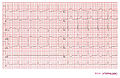 Case 3: Acute MI in a patient with LBBB