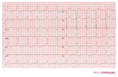 MI Diagnosis In LBBB Or Paced Rhythm ECGpedia