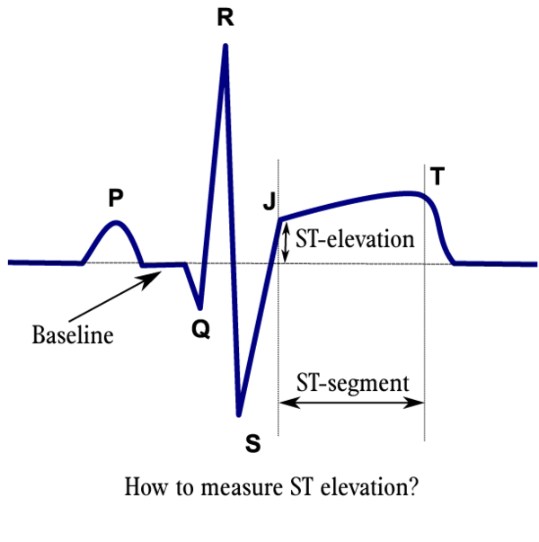 St Morphology Ecgpedia