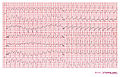 An example of idiopathic ventricular tachycardia (Belhassen VT)