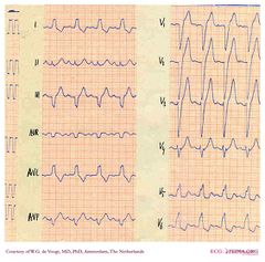 De Voogt Ecg Archive Intraventricular Conduction Ecgpedia