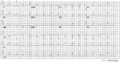 A 12 lead ECG of a patient with genetically proven LQTS2