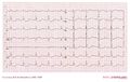 An ECG of a patient with a body temperature of 28 degrees Celsius.