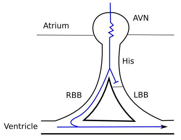 File Fixed LBBB Svg ECGpedia