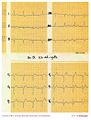 Intraventricular conduction,LBBB