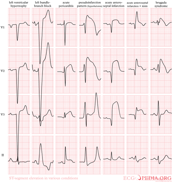 ST Morphology ECGpedia