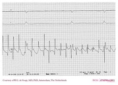 De Voogt Ecg Archive Supraventricular Rhythms Af Ecgpedia