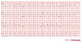 Case 2b: ECG from the same patient before the MI occured.