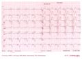 Devices,PM,Atrial standstill