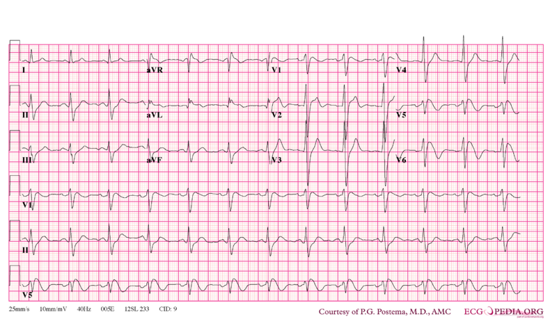 File:De-Brugada syndrome type1 example1.png
