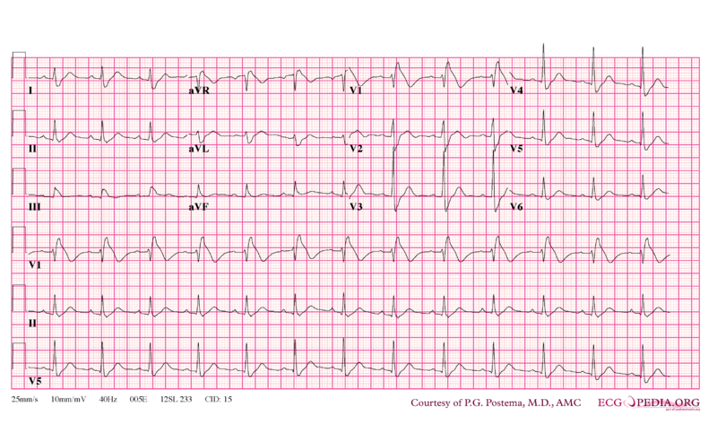 File:De-Brugada syndrome type1 example5.png