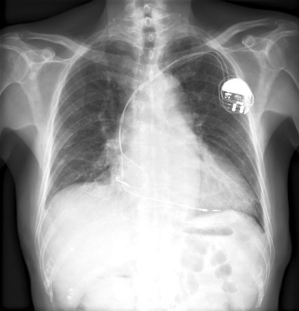 Single chamber pacemaker x ray