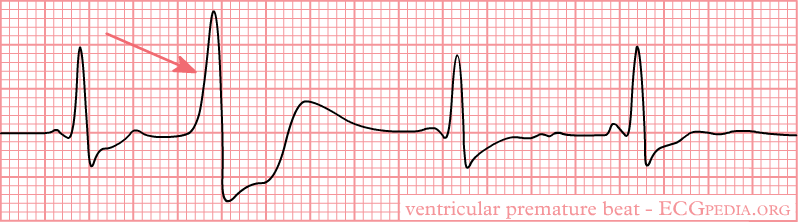 File:De-Rhythm ventricular premature.png