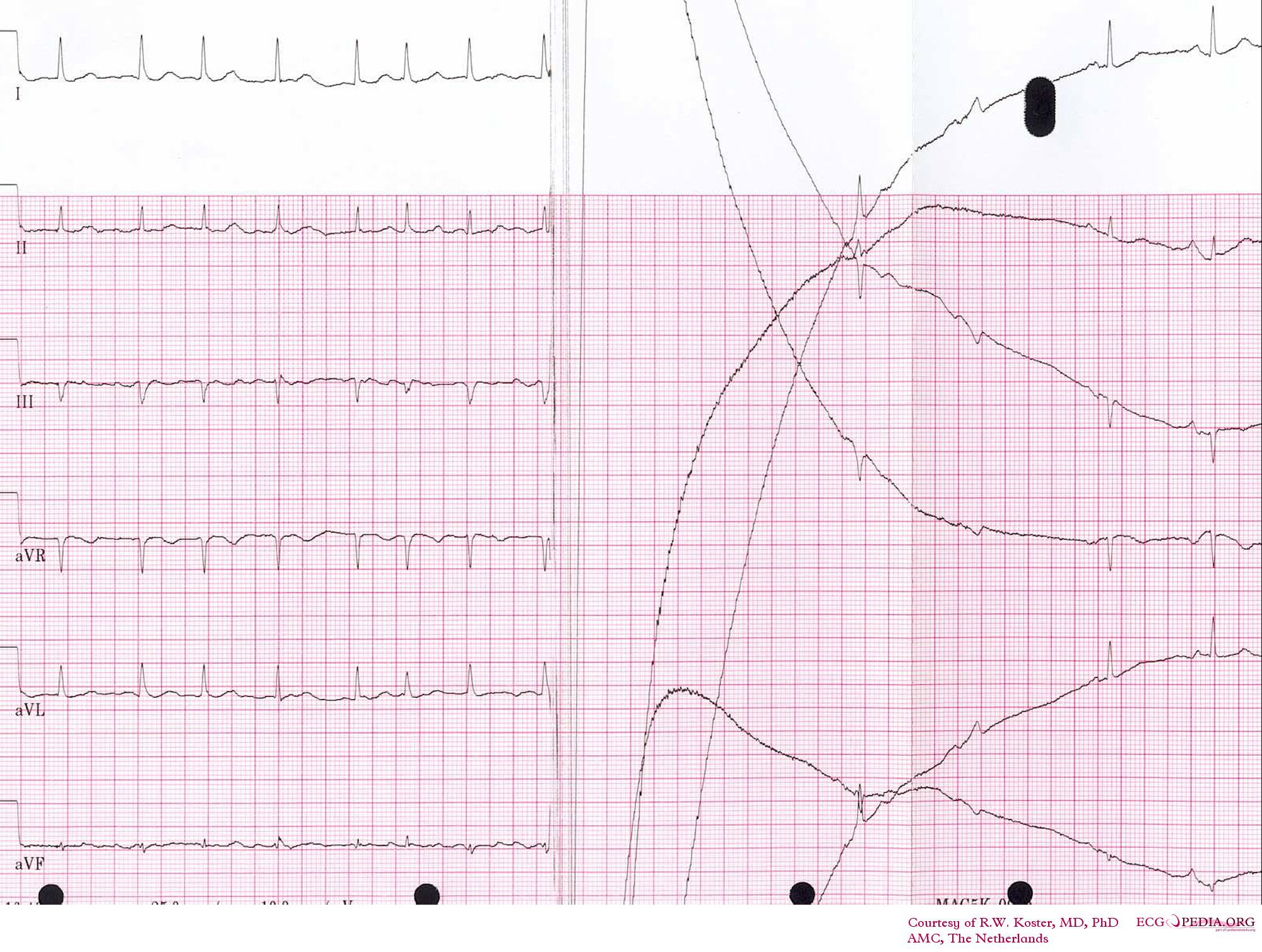 File:Cardioversion from afib.jpg - ECGpedia ecg heart diagram 