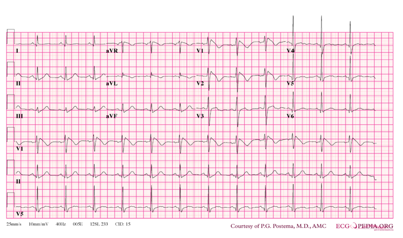 File:De-Brugada syndrome type1 example4.png