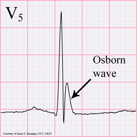 File:Osborn-wave.gif