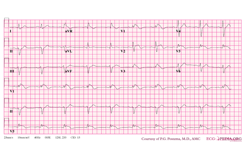 File:De-Brugada syndrome type1 example2.png