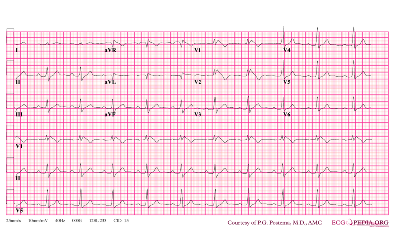File:De-Brugada syndrome type1 example3.png