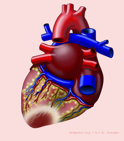 File:De-Heart with P infarct.png