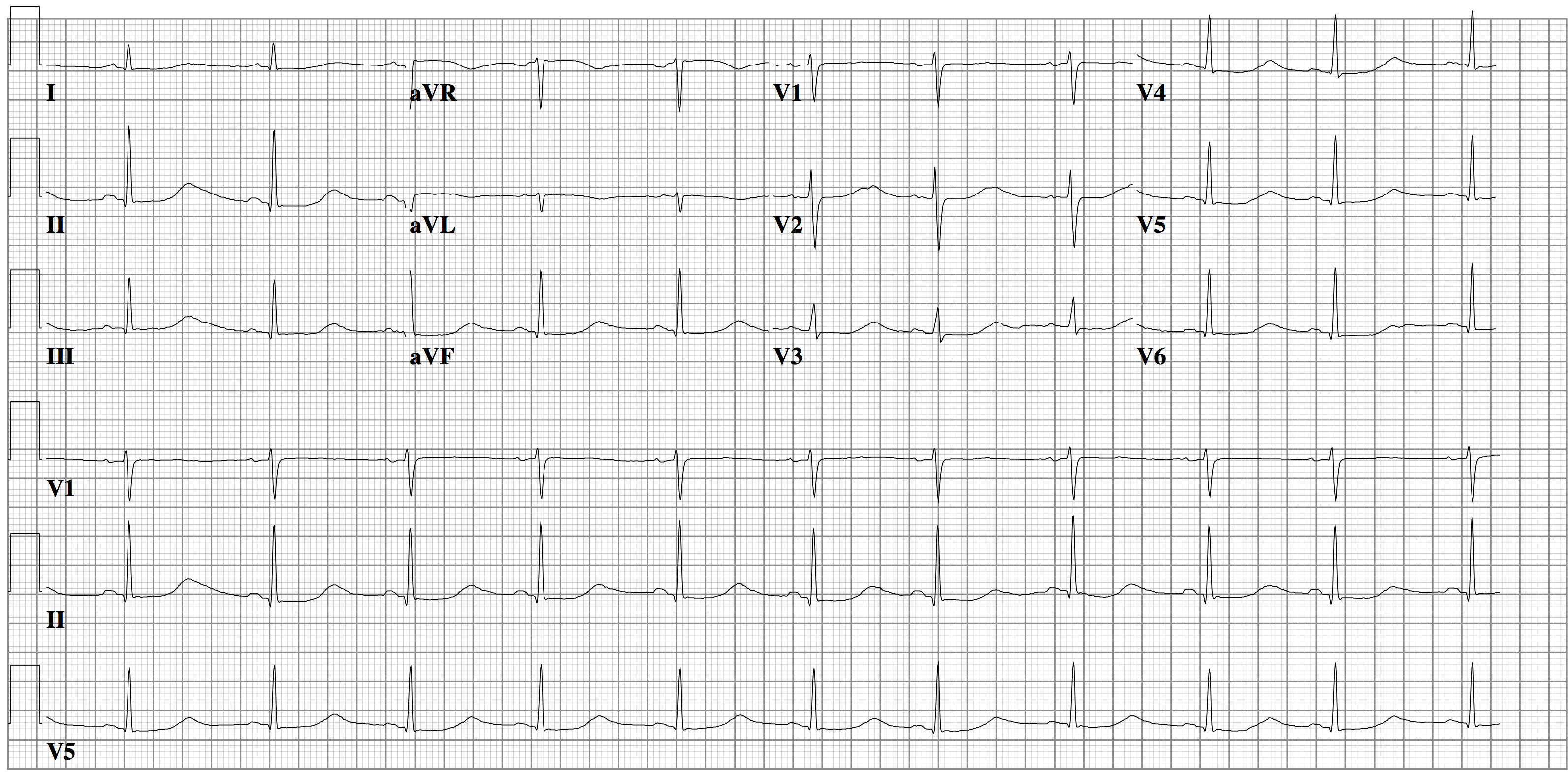 File:Lqts1.png - ECGpedia