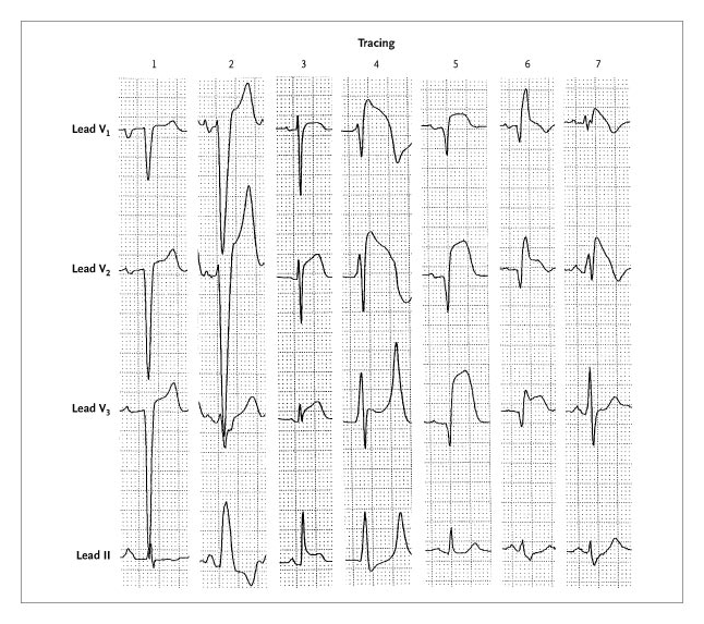 File:Pathologic ST elevation.png - ECGpedia