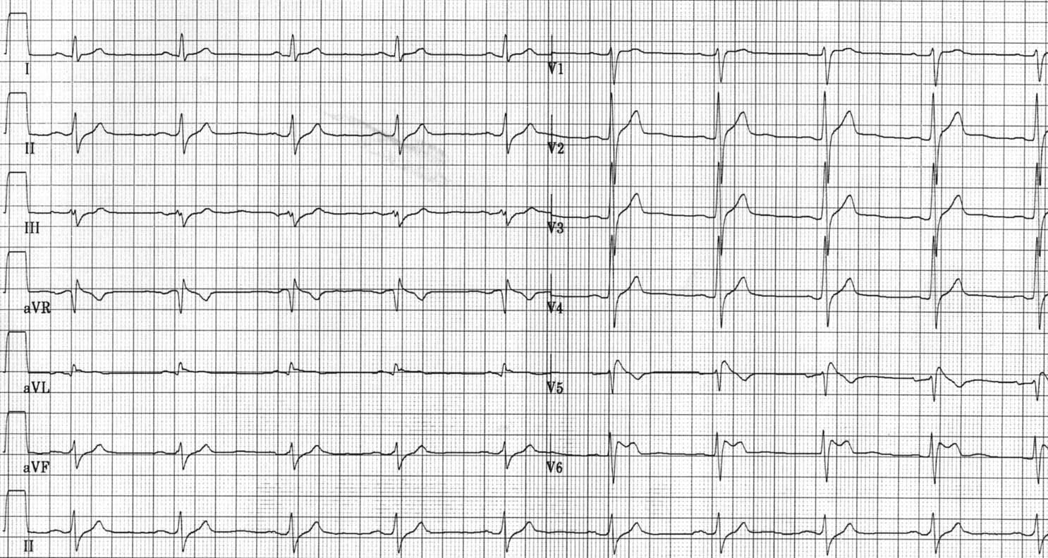 File:Puzzle 2006 1 33 fig2.jpg - ECGpedia