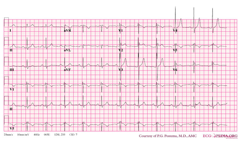 File:De-Brugada syndrome type2 example1.png