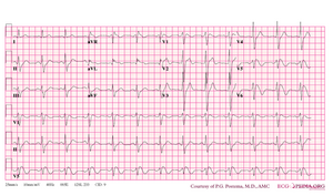 De-Brugada syndrome type1 example1.png