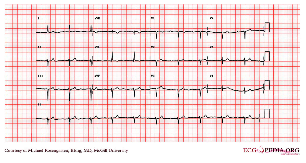 McGill Case 331 - ECGpedia