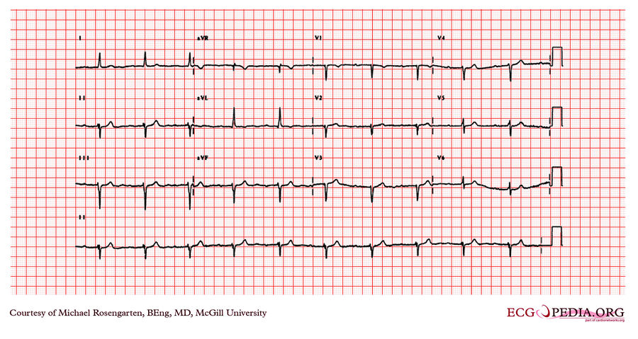 McGill Case 331 - ECGpedia