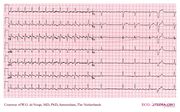 De Voogt ECG Archive - Supraventricular Rhythms - AF - ECGpedia