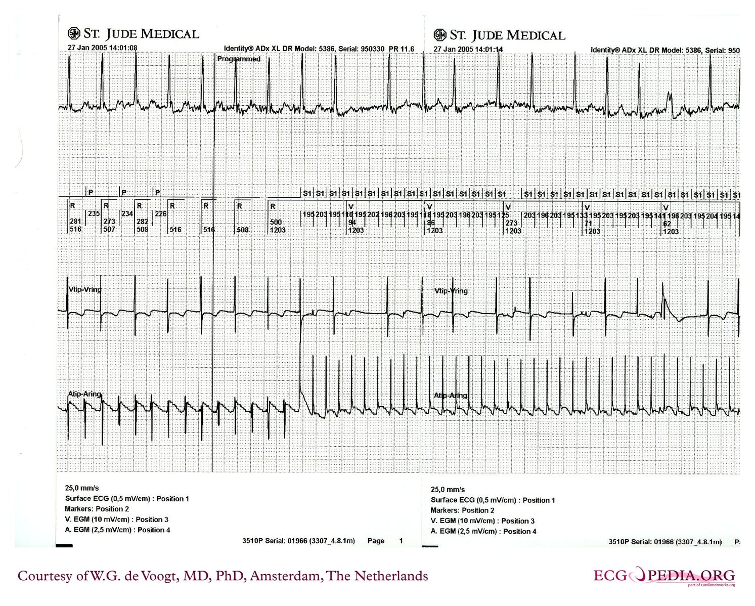 File:DVA0855.jpg - ECGpedia