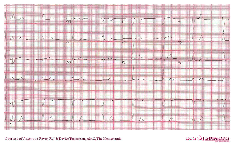 AMC Case 96 - ECGpedia