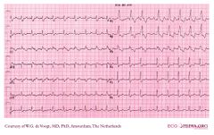 De Voogt ECG Archive - Supraventricular Rhythms - Atrial tachycardia ...