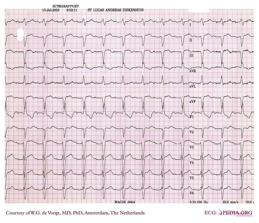 File:DVA1980.jpg - ECGpedia