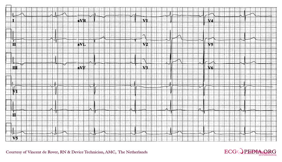 AMC Case 246 - ECGpedia