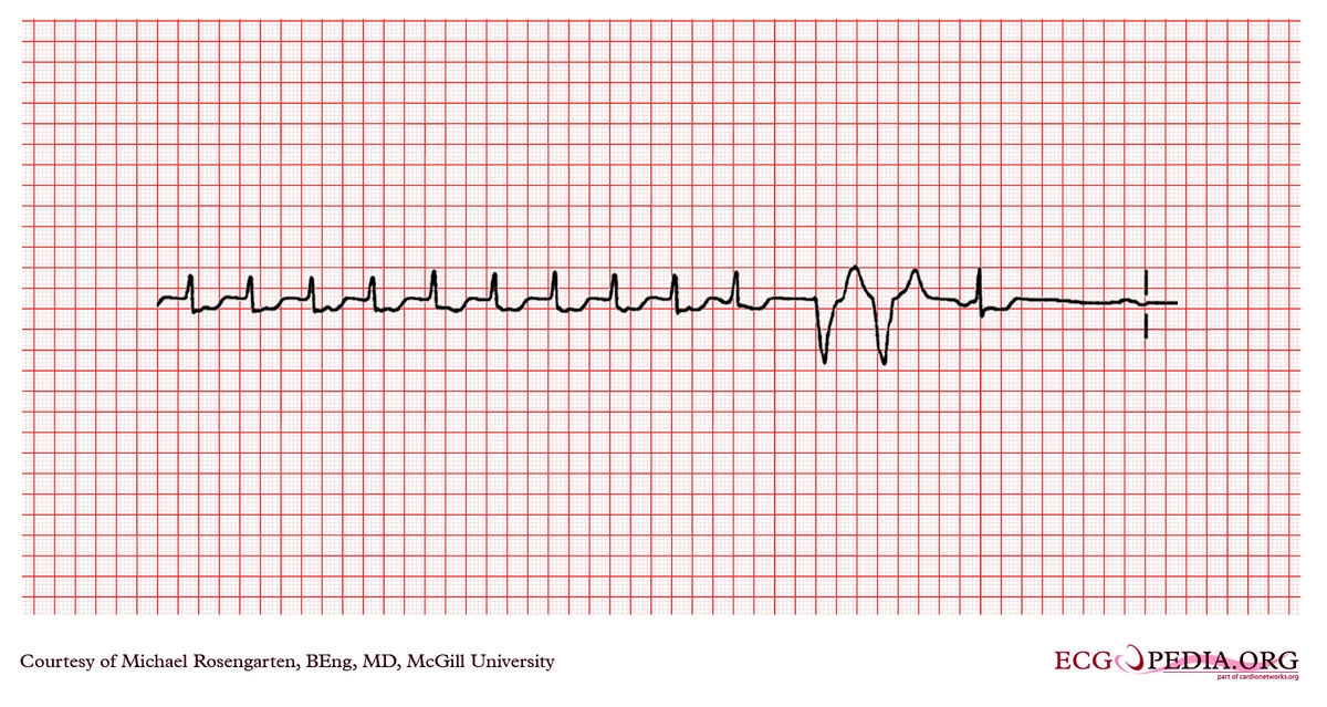 McGill Case 345 - ECGpedia