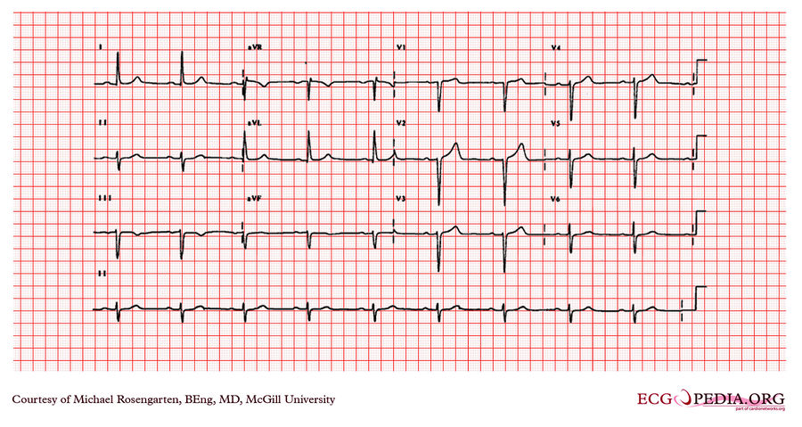 McGill Case 211 - ECGpedia